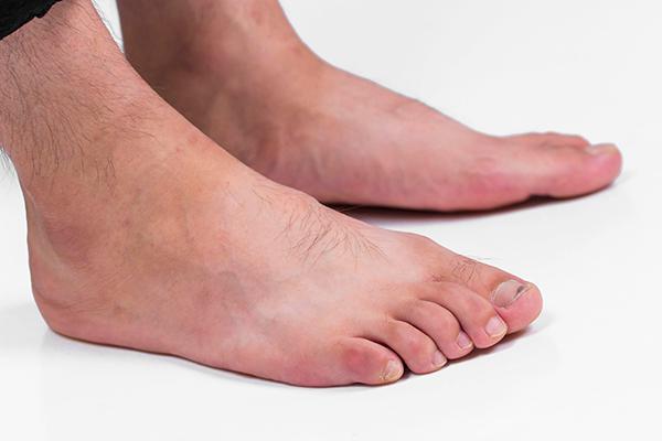 肝病一发现就是晚期?双腿不断释放的“预警信号”,都被人无视了休闲区蓝鸢梦想 - Www.slyday.coM 肝病一发现就是晚期?双腿不断释放的“预警信号”,都被人无视了休闲区蓝鸢梦想 - Www.slyday.coM