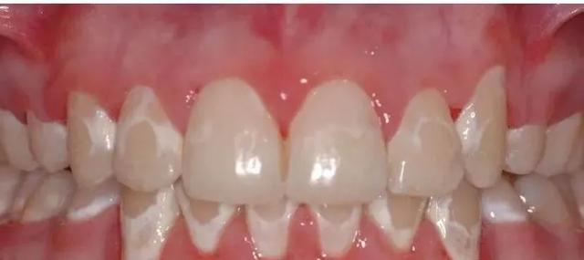 牙齿脱矿白斑能否恢复 门牙白斑怎么修复最好