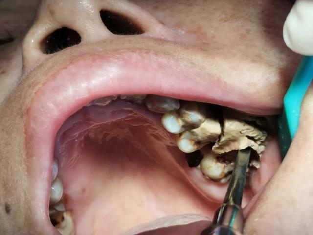 这么大的牙结石你见过吗