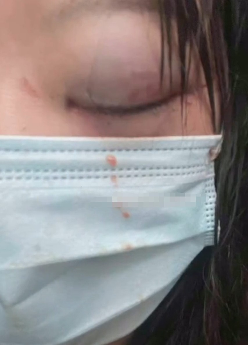 24岁网红疑被家暴眼睛肿得青紫睁不开口罩留着血迹让人好心疼
