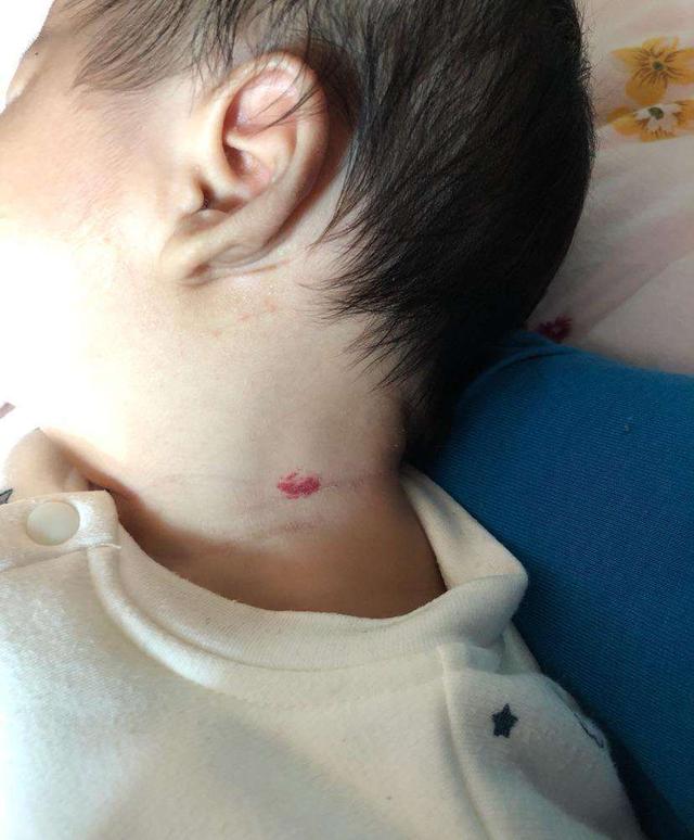 鲜红斑痣等胎记,只要不是长在正脸上了,没大面积的挡住了眼睛鼻子,不