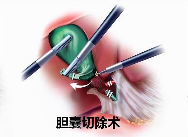 腹腔镜胆囊切除术是目前治疗胆囊结石的"金标准".