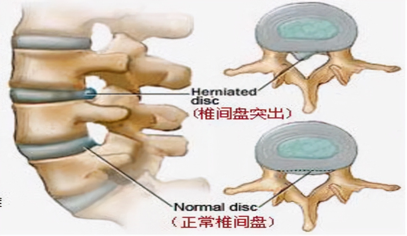 腰椎间盘膨出与突出有什么不同?|腰椎间盘|症状|游离_新浪新闻