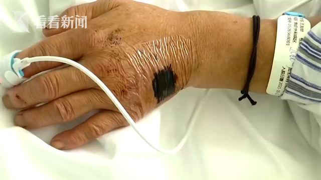 如果早期没有出现这些情况,马蜂蜇伤(伤口)数量不是特别多,我们可以