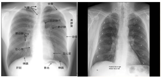 槲皮素对肺部健康的多重作用 槲皮素口服饮和清肺丸的功效有哪些