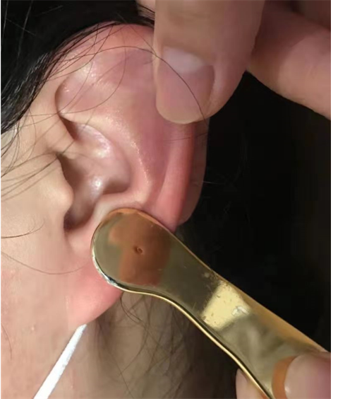 不怕失眠来困扰耳穴助眠有妙招