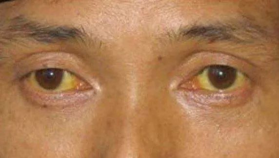 脸上出现4个表现,肝脏要崩溃,六大伤肝"凶手",一一揭晓__财经头条