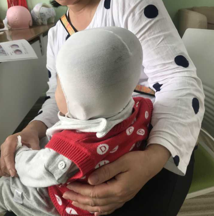 婴儿头型矫正每天戴23小时头盔请别让孩子为你的愚蠢买单好么