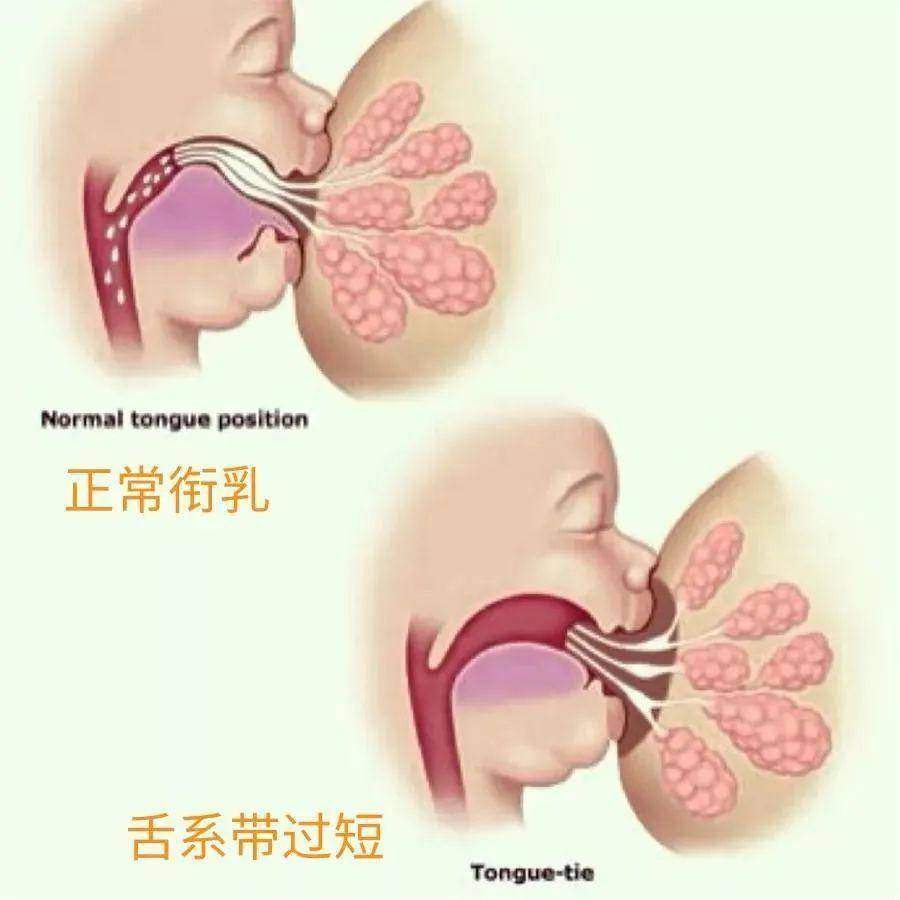 孩子舌系带过短宝爸宝妈们要注意啦