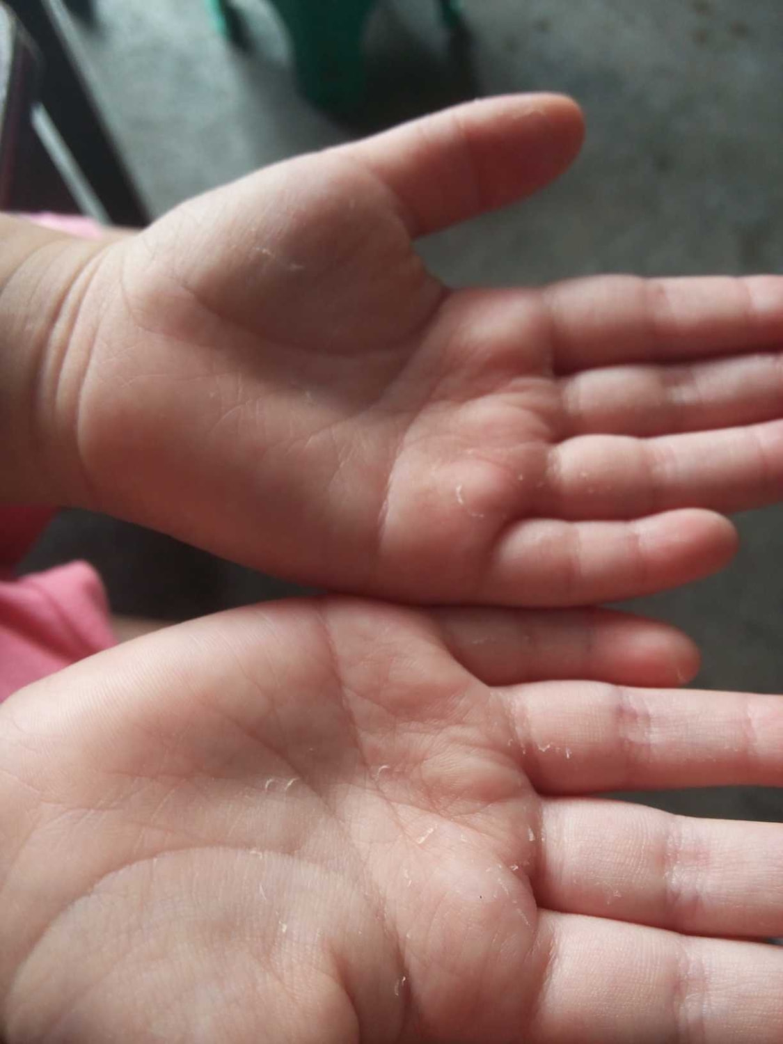 小儿推拿杨晓孩子手脱皮是怎么回事如何应对和预防宝宝手脱皮