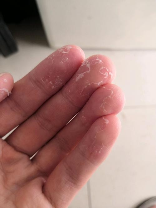 小儿推拿杨晓孩子手脱皮是怎么回事如何应对和预防宝宝手脱皮