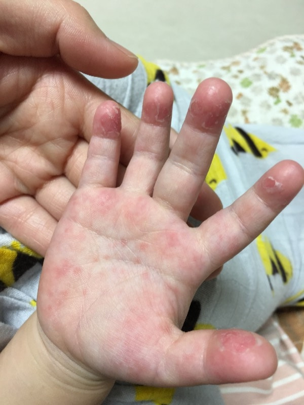 小儿风疹的症状和治疗图片