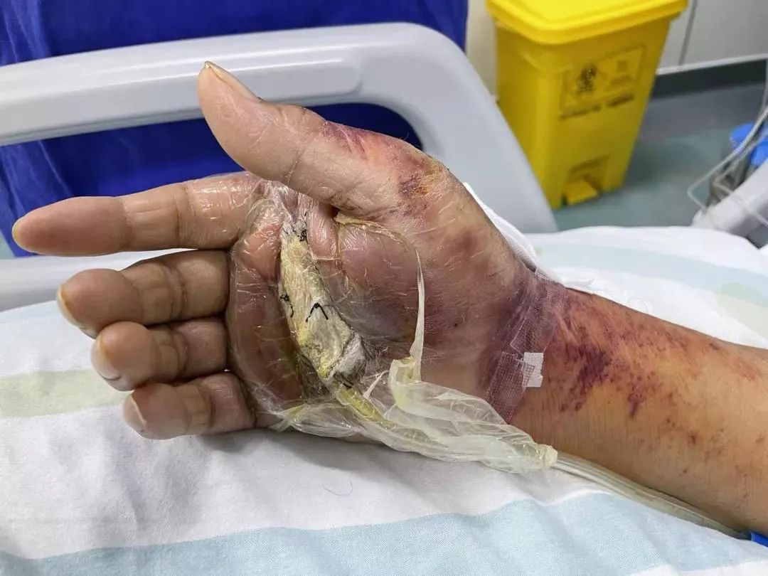 手被鱼刺扎了一下深圳男子差点丧命