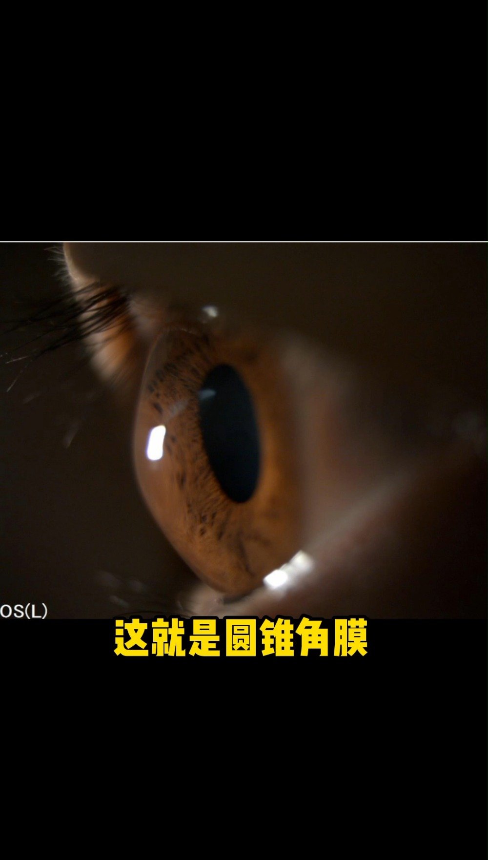 显微镜下的圆锥角膜