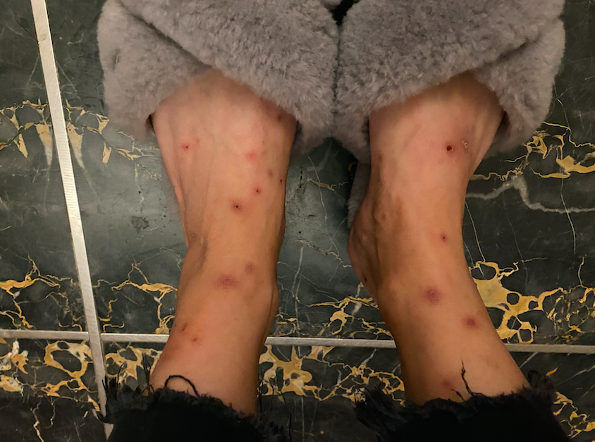 居民的腿被跳蚤咬得全是疙瘩