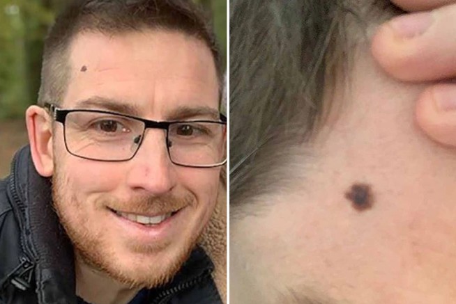 视频通话时被母亲发现脸上多了一颗痣,男子就医才知