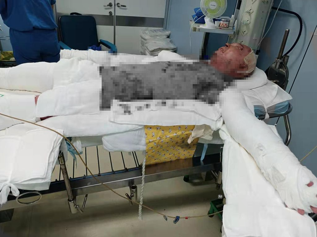鄄城男子做饭时煤气爆炸，全身被90%烧伤，火海逃生后再陷困境休闲区蓝鸢梦想 - Www.slyday.coM