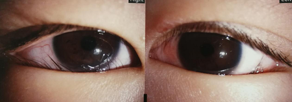 7岁男孩难忍倒睫折磨,爱尔眼科公益救助重拾生活信心|爱尔眼科|倒睫