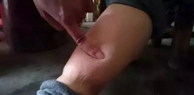 22岁小伙,查出尿毒症,1件事做得太多了休闲区蓝鸢梦想 - Www.slyday.coM 22岁小伙,查出尿毒症,1件事做得太多了休闲区蓝鸢梦想 - Www.slyday.coM