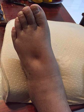 大爷下肢水肿发黑8个月确诊多亏唐诗三百首