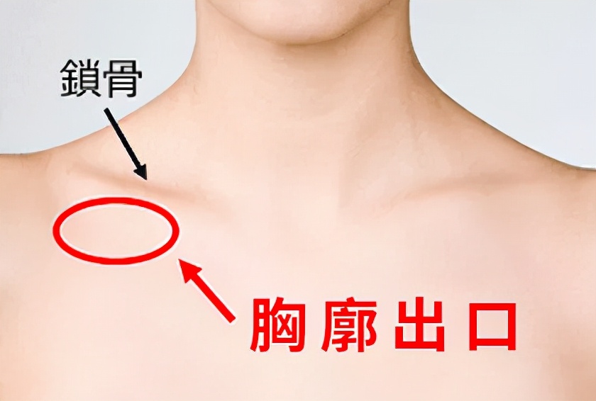 2,血管受压:锁骨下动脉受压时,主要表现为手发冷,苍白,疼痛,上肢下垂