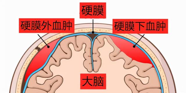硬膜外出血通常是因为颅脑受伤,使硬脑膜外层(包裹大脑的三层薄膜中最