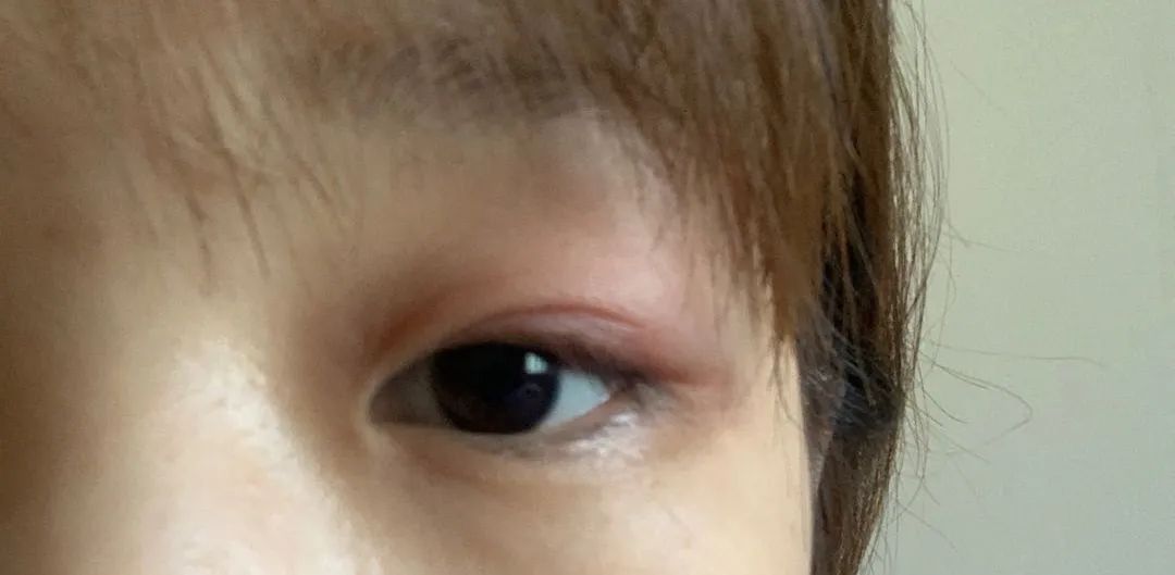 像图片上的这种睑腺炎,热敷 3～5 天,大部分可以得到一个良好的恢复.