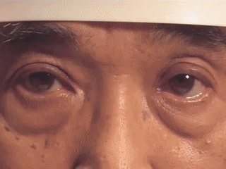 这8种眼震你都能分清吗附动图及影像