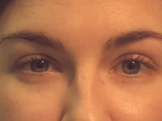 这 8 种眼震,你都能分清吗?(附动图及影像)