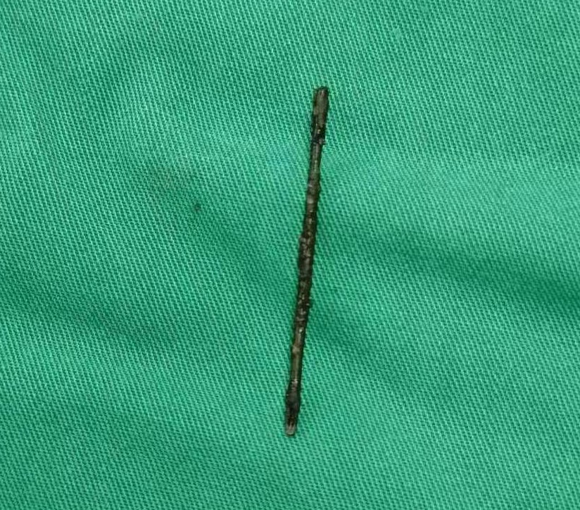 差点出大事！一根绣花针竟在女子身体里藏了20多年……休闲区蓝鸢梦想 - Www.slyday.coM