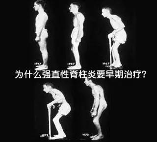 强直性脊柱炎为什么会驼背或僵直?