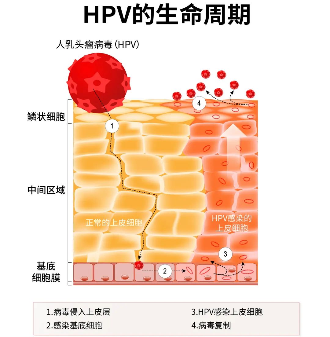 高危型hpv感染多能引起宫颈病变,但病变不是一蹴而就的,要经历感染