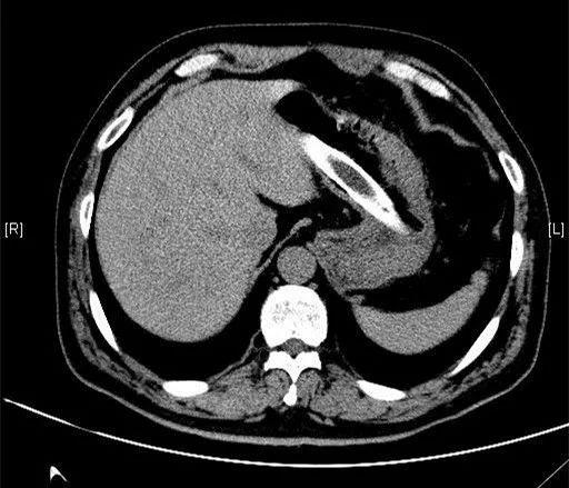 海口一男子胃里取出衣架、塑料管！在肚里待了3个月！医生都惊了……休闲区蓝鸢梦想 - Www.slyday.coM