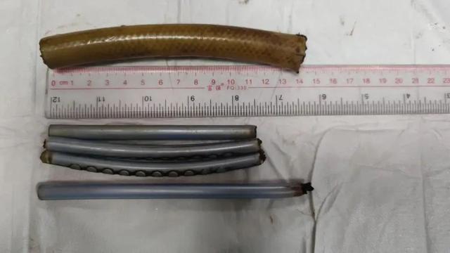 海口一男子胃里取出衣架、塑料管！在肚里待了3个月！医生都惊了……休闲区蓝鸢梦想 - Www.slyday.coM