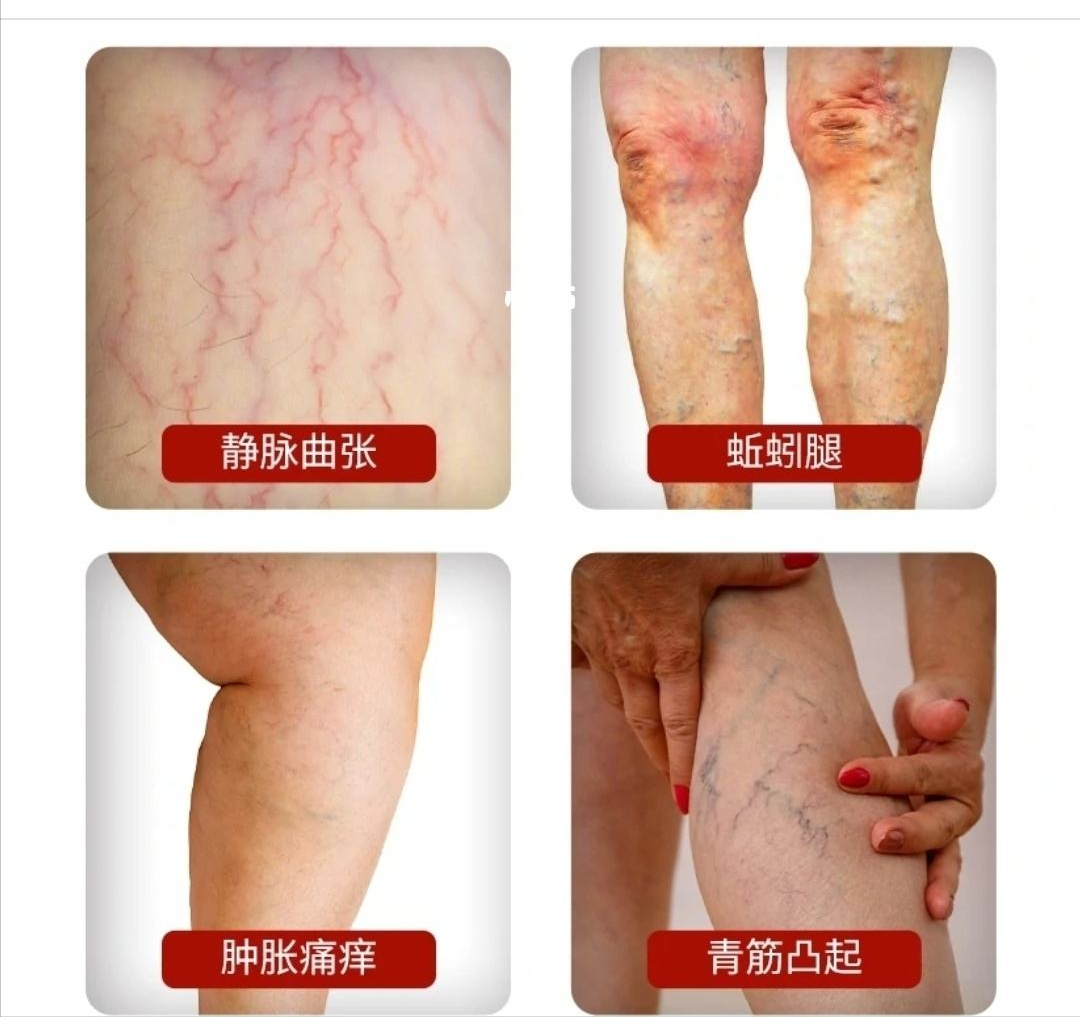 "蚯蚓腿"瘙痒溃烂 消融封闭"坏血管"|蚯蚓|血管|消融_新浪新闻