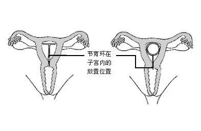 由于当时没有按照个人身体定制节育环的过程,大部分女性佩戴的都是同