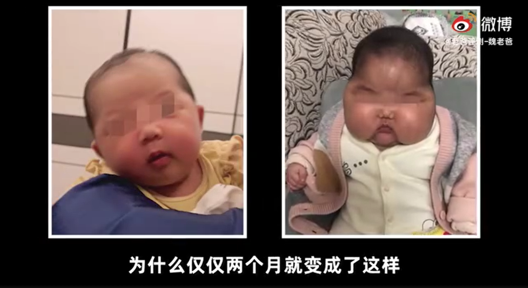 母婴周刊：婴儿用抑菌霜成“大头娃娃” 发育迟缓脸部肿大