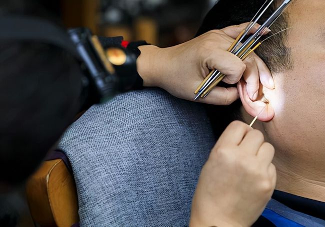 男子60元采耳后,为何又花了1800元治病?|耳屎|耳朵|真菌_新浪新闻