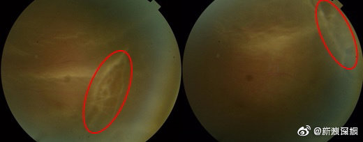 高度近视男子踢足球后视网膜裂了 需终身避免剧烈运动休闲区蓝鸢梦想 - Www.slyday.coM