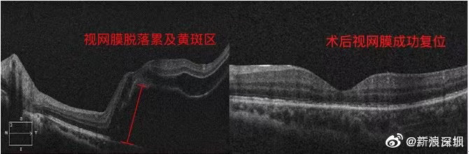 高度近视男子踢足球后视网膜裂了 需终身避免剧烈运动休闲区蓝鸢梦想 - Www.slyday.coM