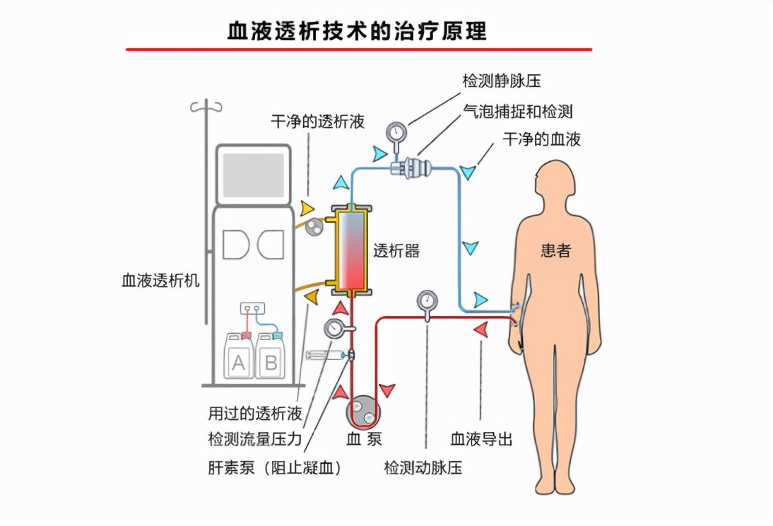 血透机是血液净化市场重要的医疗器械之一,也是终末期肾病(esrd,即