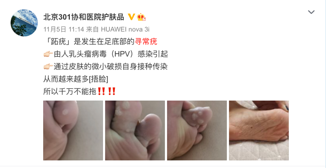 身上莫名长出的小肉揪揪是感染了病毒一篇文章全说清