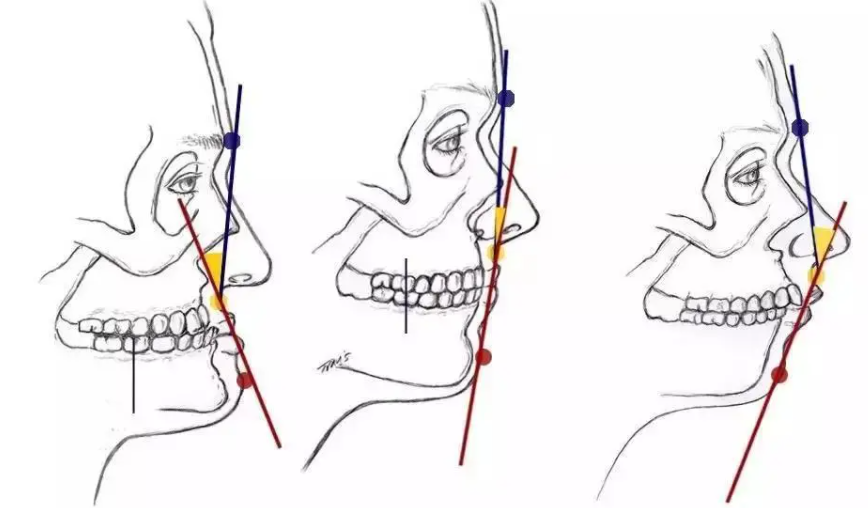 这两种牙齿情况统称为"牙列不齐",在医学上又被称为"牙颌面畸形"