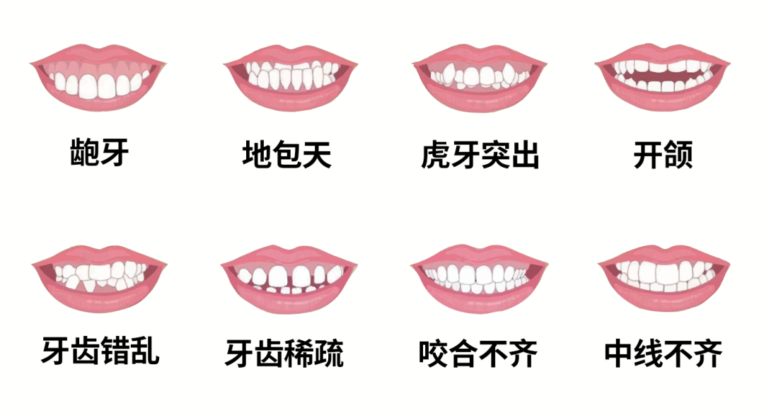 常见的几大错颌畸形类型