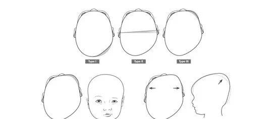 斜头畸形示意图