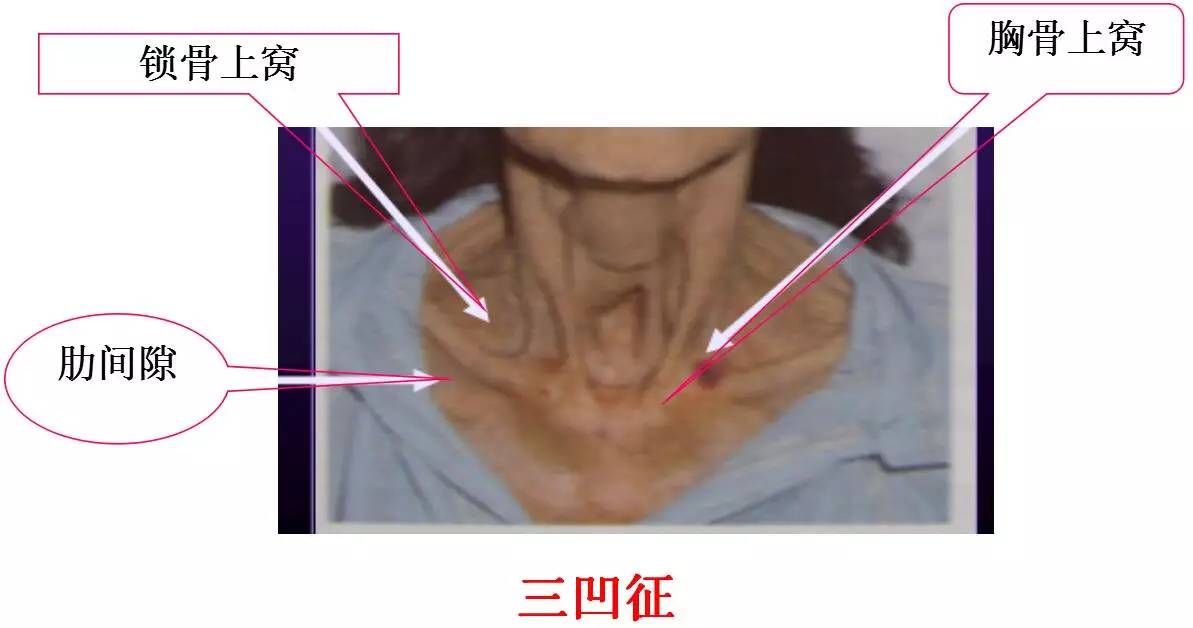 世界肺炎日感冒和肺炎傻傻分不清楚医生教你从这6点来区分