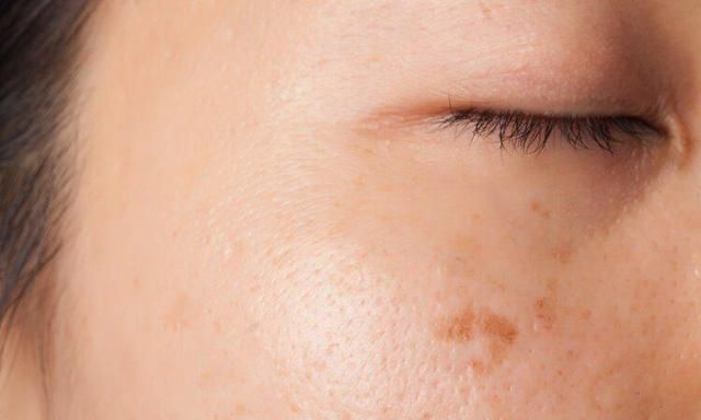 脸上很多老年斑教你4个方法让老年斑迅速退场