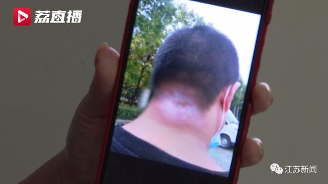 男子随手挤了颗痘痘结果长出拳头大脓包