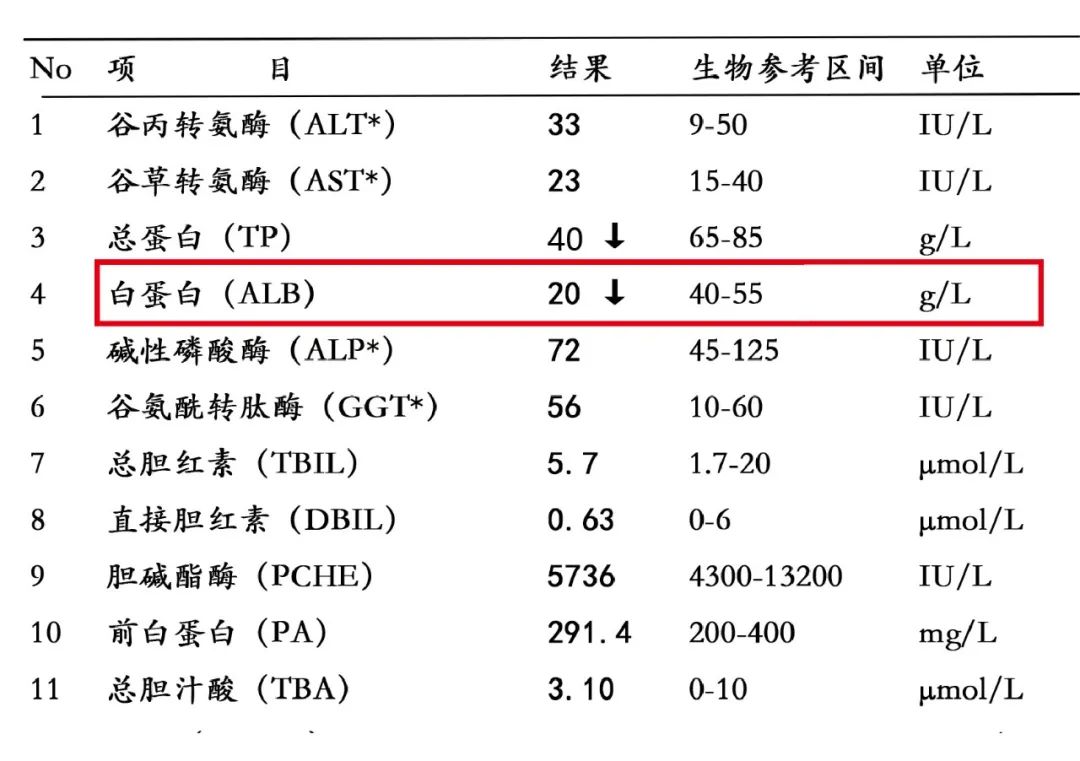 5g;血白蛋白明显低于正常值,医生会写上"肾病综合征"这个诊断.