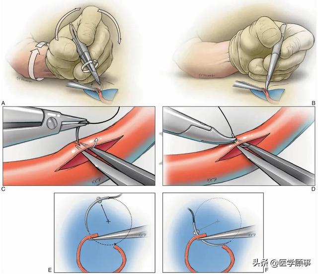 进针过程就是使缝合针穿过血管壁并转移到对侧的器械上,分为进针,夹持